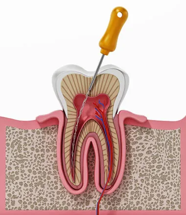 Painless Root Canal